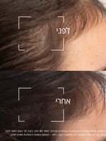 שלישיית סרום נגד נשירת שיער